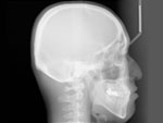頭蓋骨を横から撮影したレントゲン写真