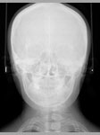 頭蓋骨を前から撮影したレントゲン写真